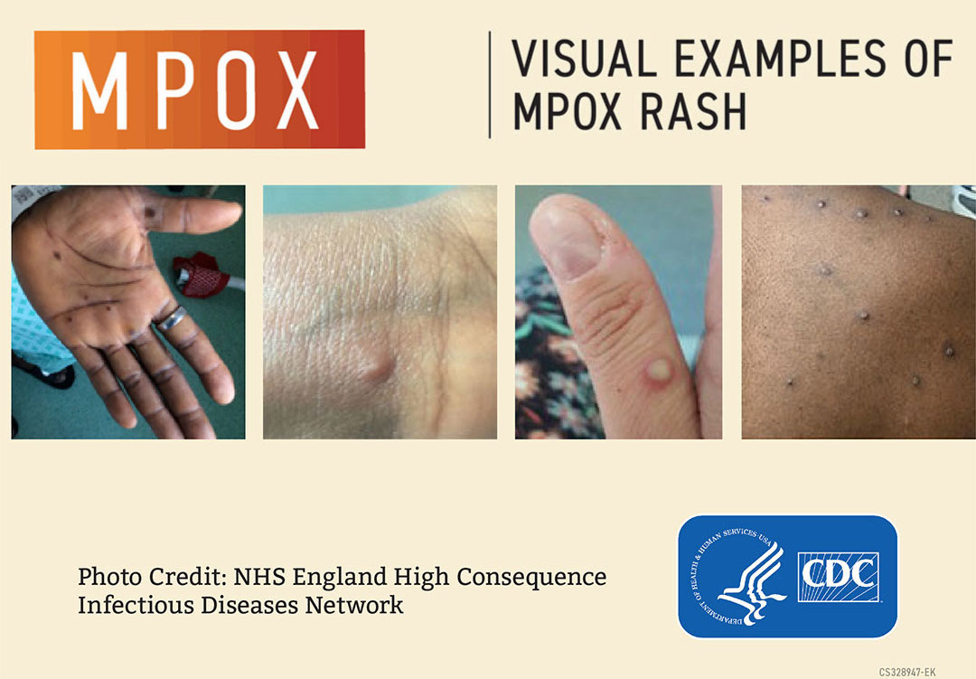 mpox examples