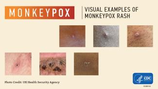 Monkeypox 1