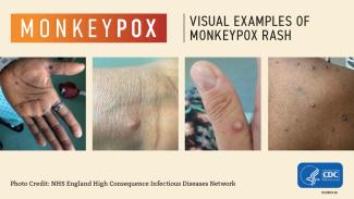 monkeypox2