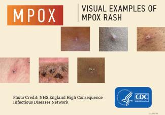 mpox examples 2